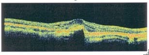 Optical coherence tomography scan showing fluid in the retina