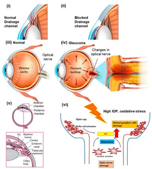 Diagram comparing a normal eye and one with open-angle glaucoma