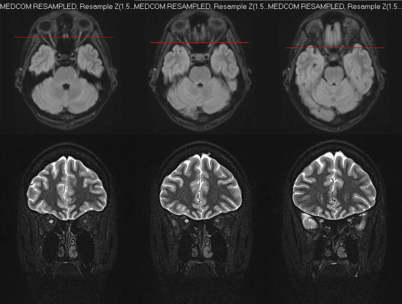 MRI slice highlighting T2 hyperintensity of the right optic nerve.