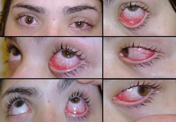 Collage of an eye with viral conjunctivitis
