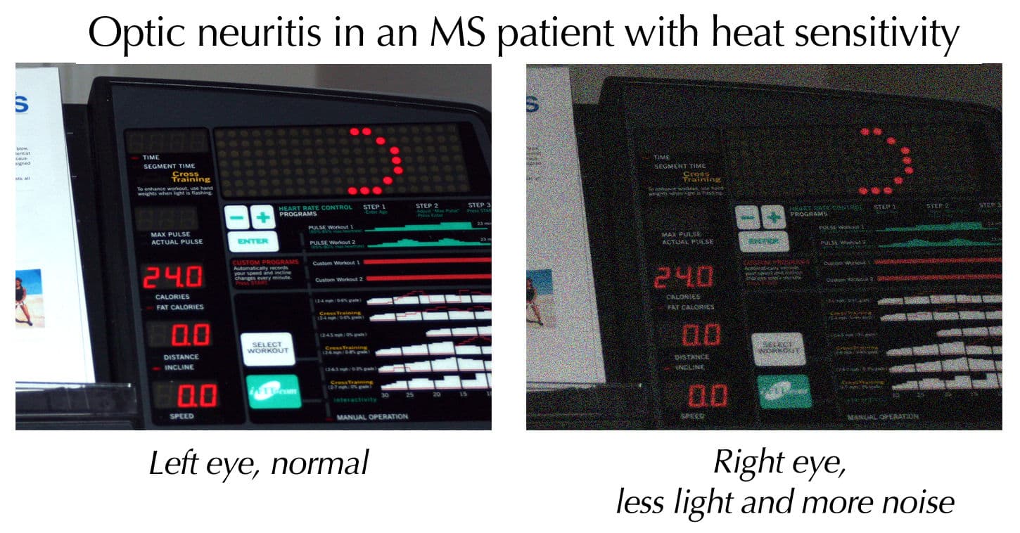 Side-by-side demonstration image illustrating the visual effect of optic neuritis