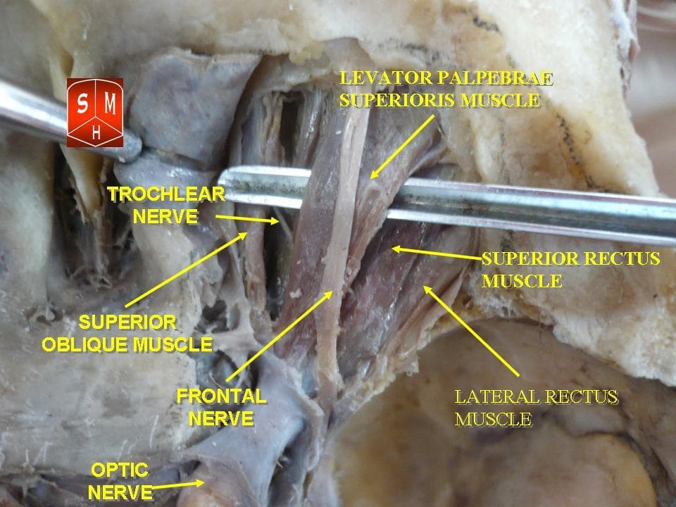 Anatomy illustration of the six extra-ocular muscles around the eyeball.