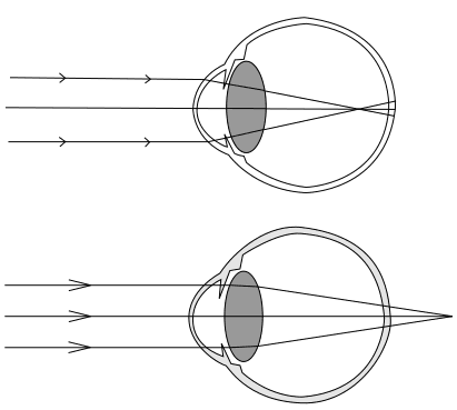 Diagram comparing normal vision and myopia