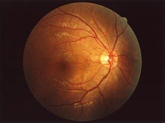 Color fundus photograph of a normal human retina