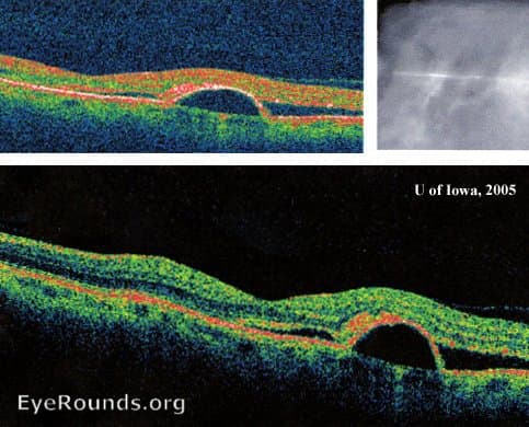 Optical coherence tomography scan depicting sub-retinal fluid and a pigment-epithelial detachment.