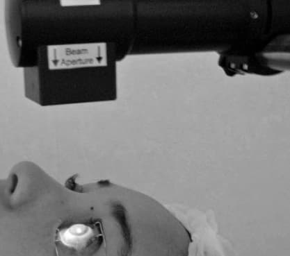 Patient lying under a calibrated UVA lamp during corneal cross-linking