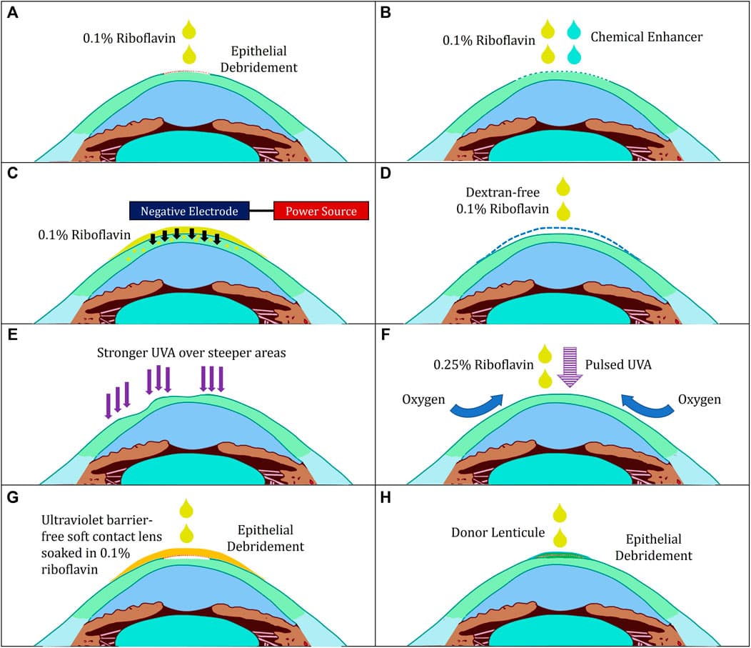 Applying riboflavin drops to the cornea before UVA exposure