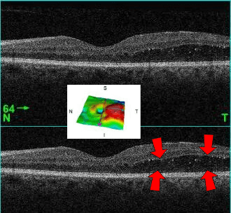 OCT cross-sections with red arrows showing intraretinal fluid pockets typical of diabetic macular edema
