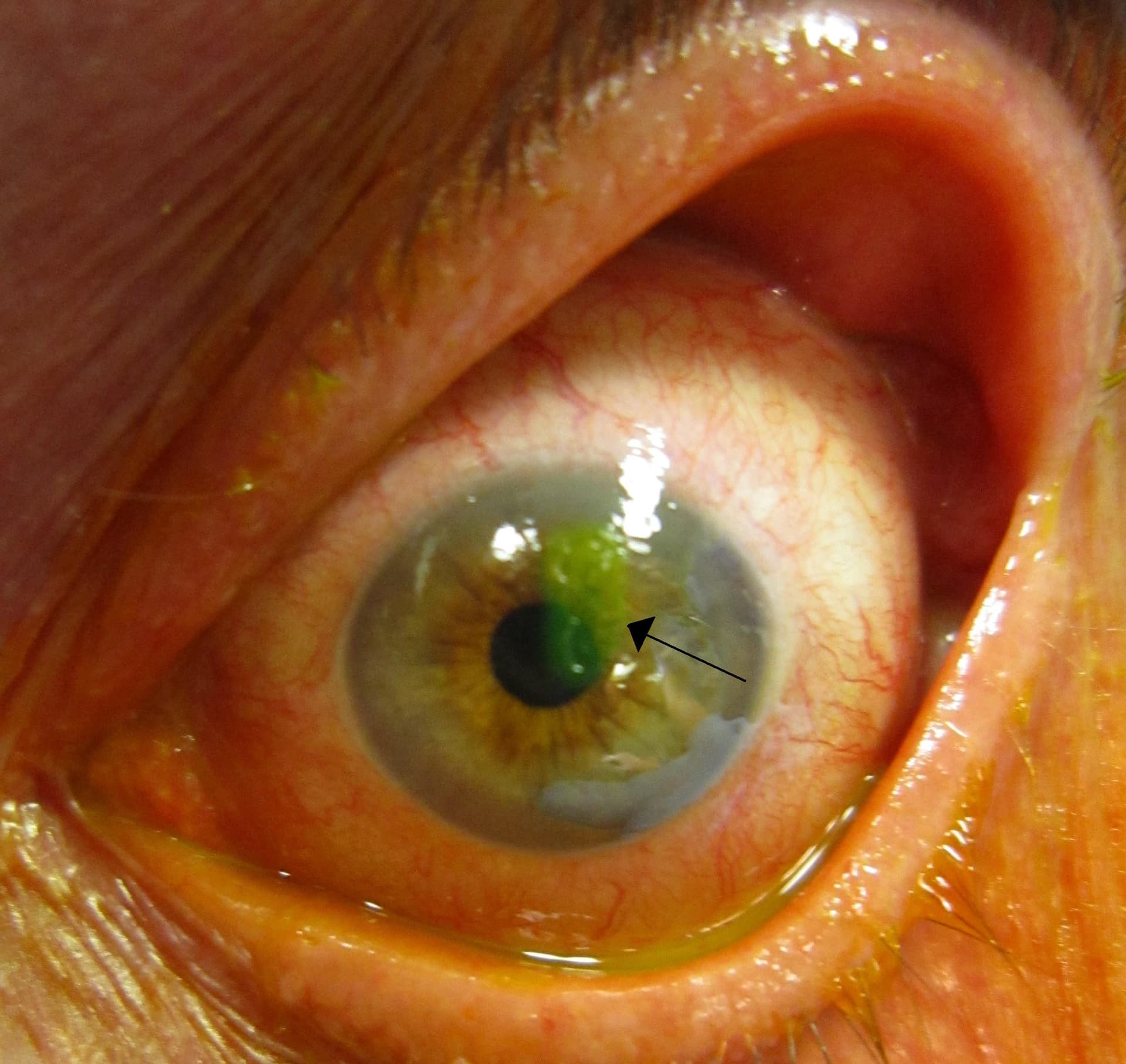 Fluorescein dye highlighting scratches on the cornea under blue light