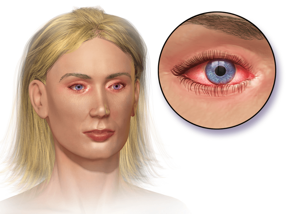 Medical illustration of a woman with red, itchy eyes and an inset of the inflamed eye surface