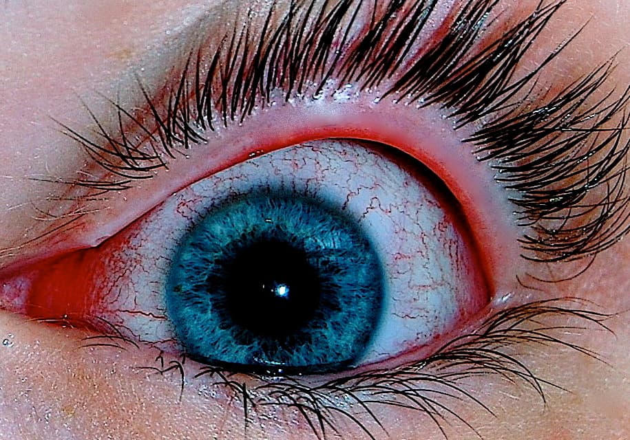 Close-up of an eye with viral conjunctivitis showing red, irritated conjunctival vessels.