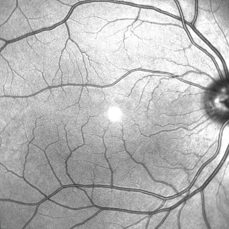 Infrared reflectance retinal image used during OCT-based eye exams