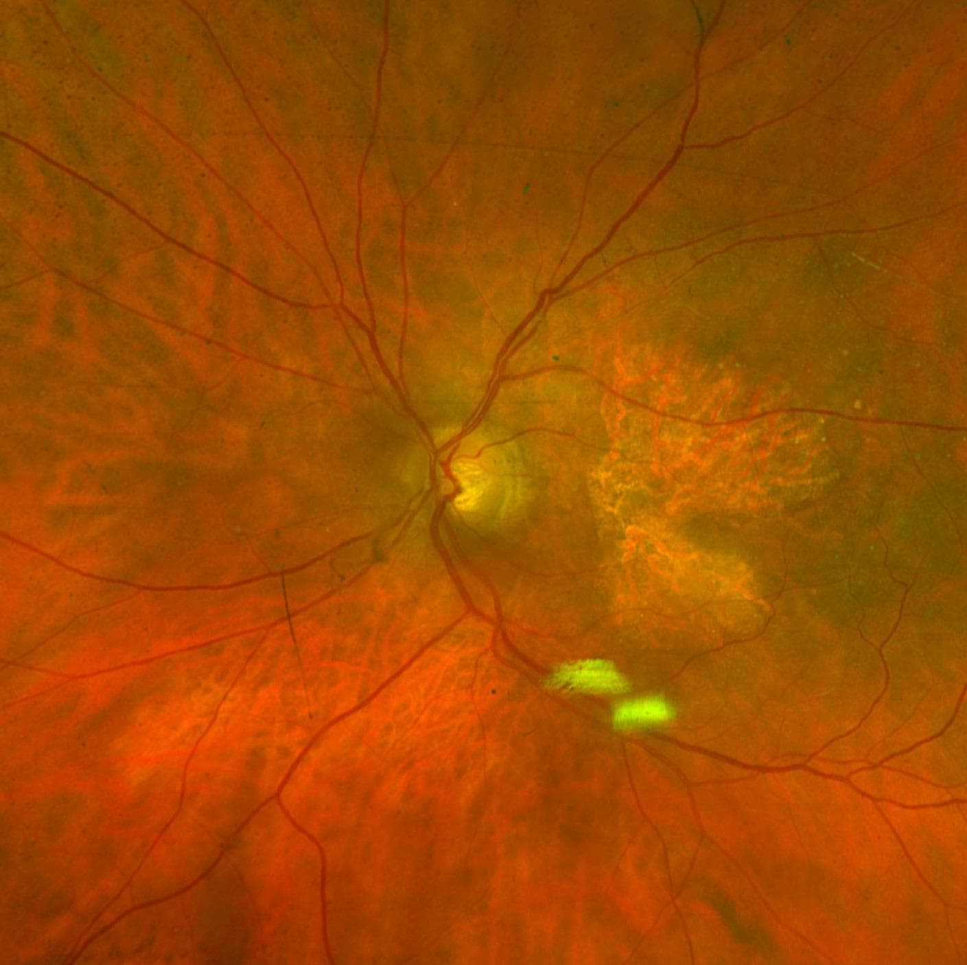 Color fundus photograph with pale, well-defined areas of geographic atrophy near the macula