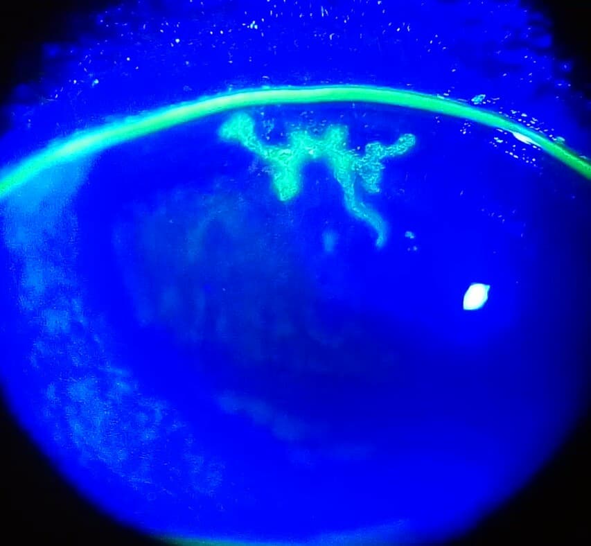 Fluorescein-stained cornea showing a dendritic ulcer typical of herpes simplex epithelial keratitis