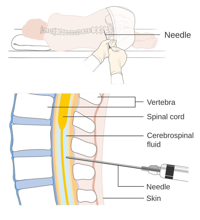 Diagram of lumbar puncture showing patient position and needle path