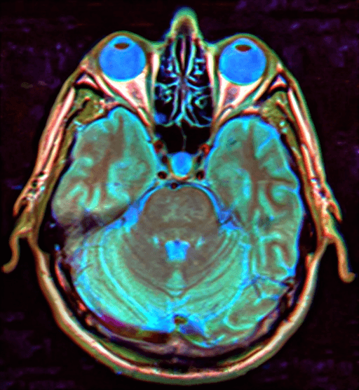 Axial brain MRI showing features consistent with empty sella