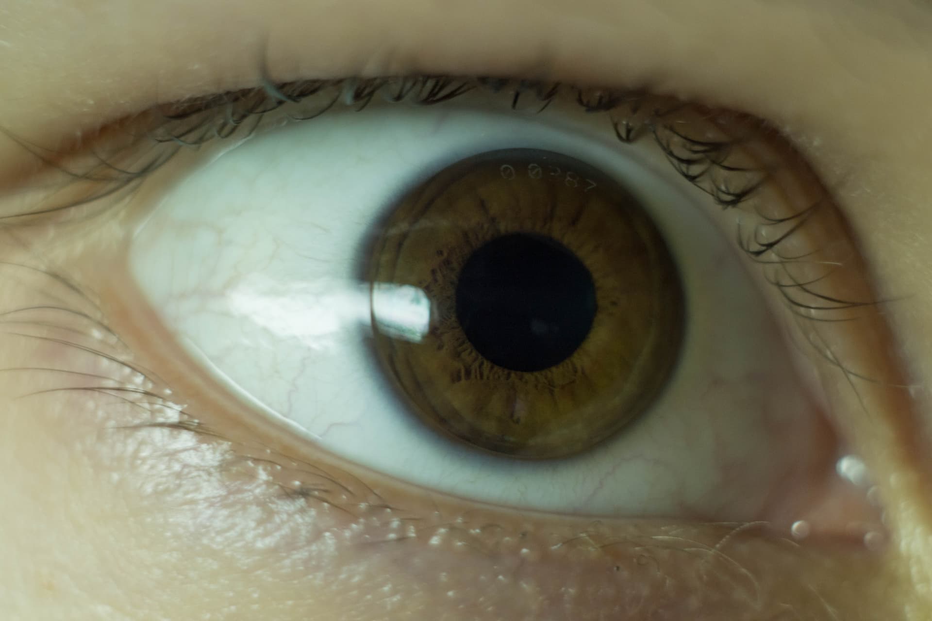 Close-up of an orthokeratology lens on the eye