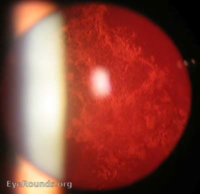 Retro-illumination view highlighting the opacified posterior capsule.