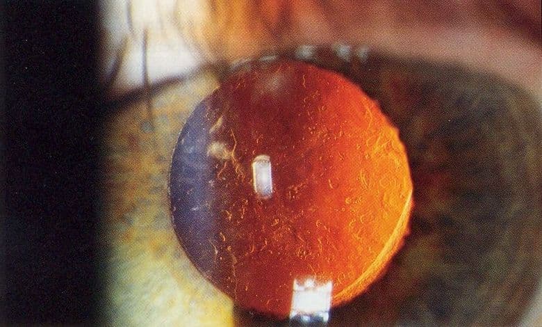 After-cataract seen on retro-illumination with an IOL in place.