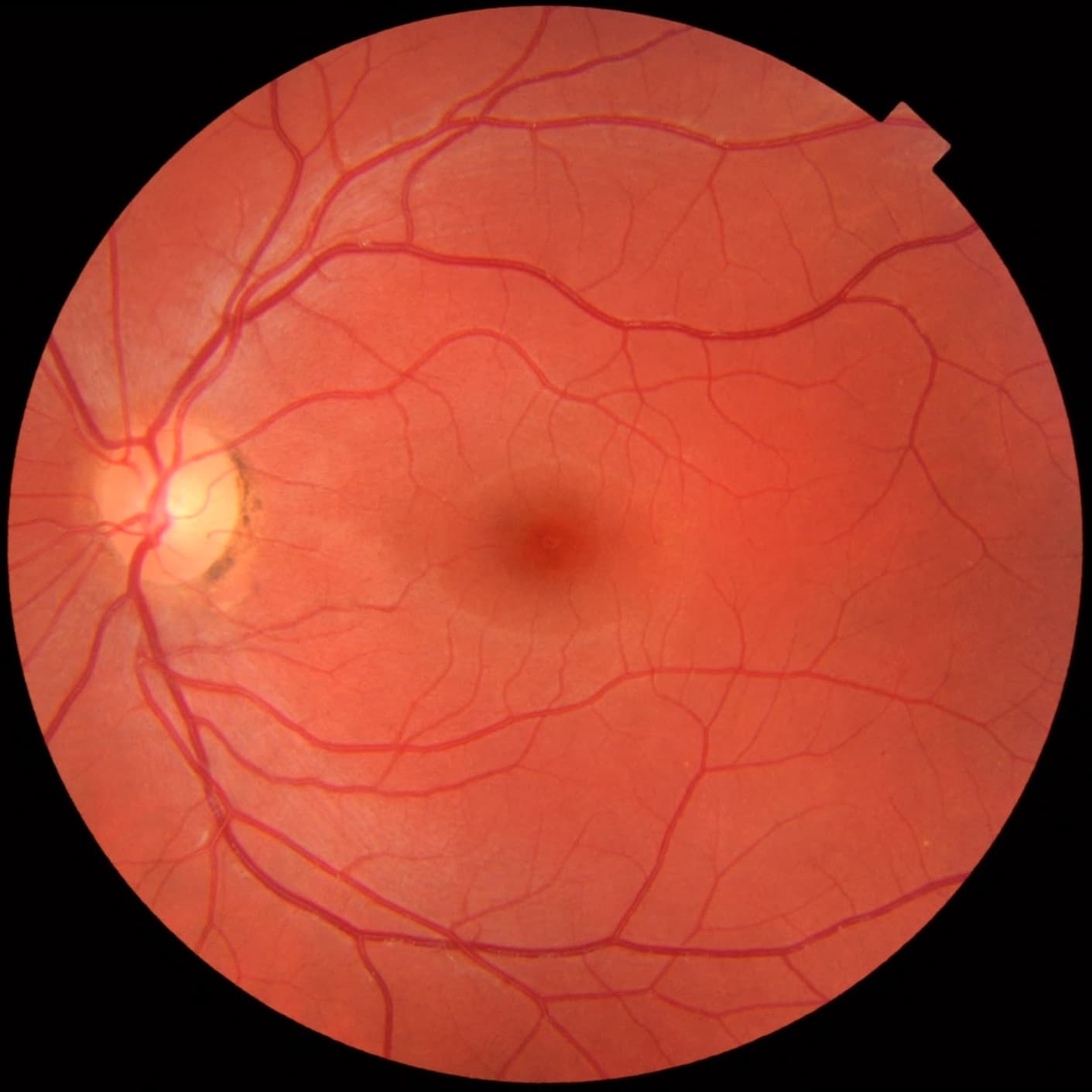 Normal fundus photograph of a healthy left eye with clear macula and optic disc