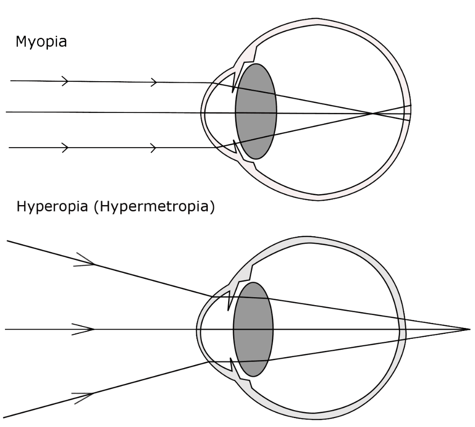 Graphic showing light mis-focusing in myopia and hyperopia