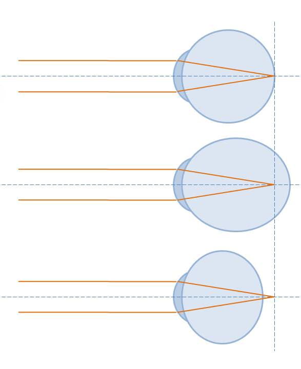 Diagram comparing normal focus with myopia and hyperopia in the eye