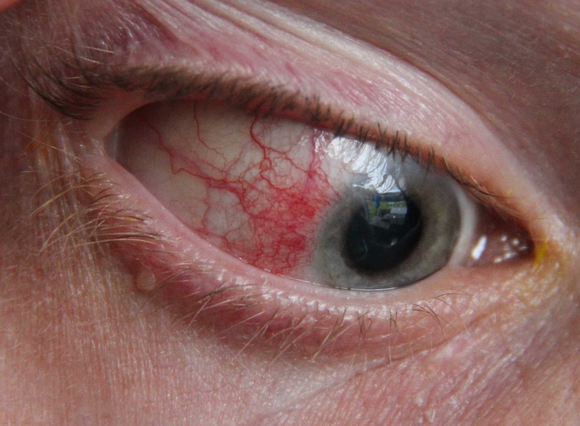 Episcleritis showing sectoral superficial redness