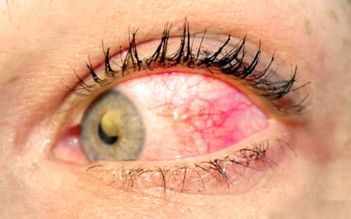 Macro photo of nodular scleritis with raised scleral nodule