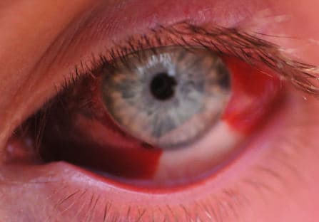 Before-and-after images showing a hemorrhage on day 1 and resolution at four weeks.