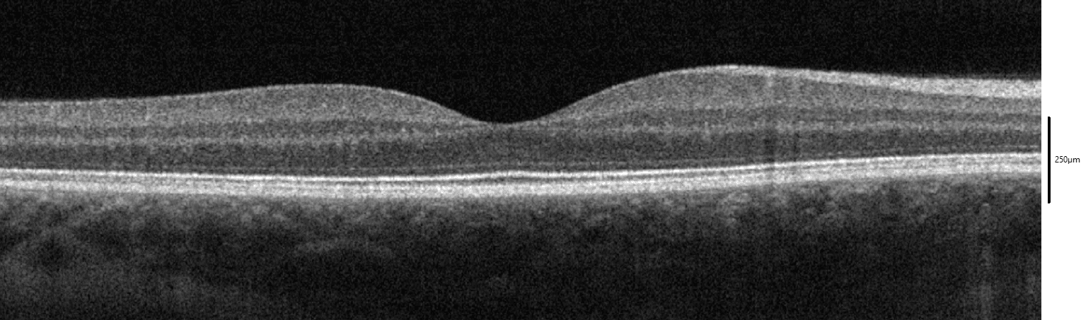 Spectral-domain OCT cross-section of a healthy macula