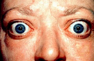 Person with bulging eyes and lid retraction due to thyroid eye disease.