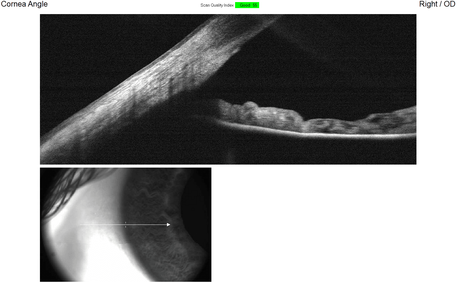 Kahook Dual Blade Goniotomy | Treatment Guide | Kerbside